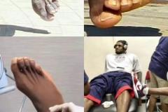 腳趾變形看著難受！看看詹姆斯在使用的腳趾分離器