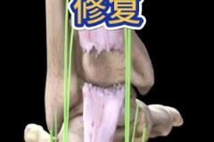 看著都疼??！科普帖：球員腳跟腱斷裂是如何進行修復(fù)的？